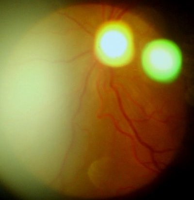 眼电图和视网膜电图_手机砸眼视网膜脱离_视网膜遗传性眼病中发病率最高的是