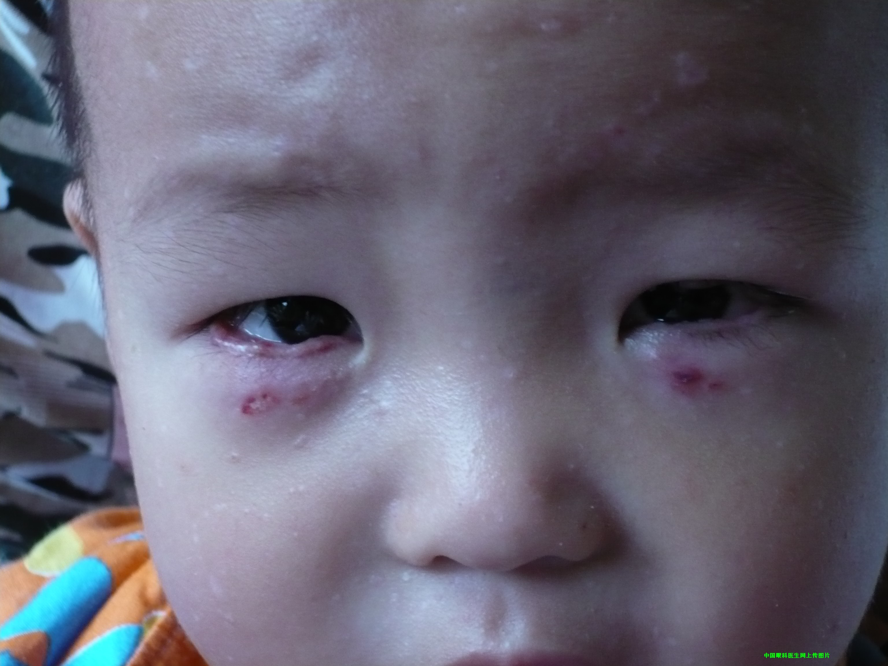 3岁小孩眼睛长瘤，养娃不易，新手爸妈一定要知道这些事...|皮样瘤|长瘤|眼睛|角膜|右眼|肿物|视力|-健康界