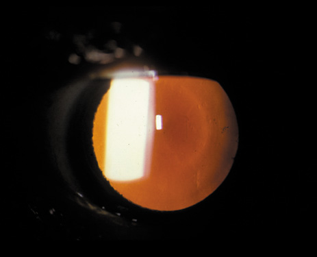 oil droplet cataract