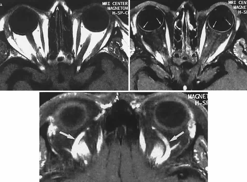 Tolosa Hunt Mri Radiology