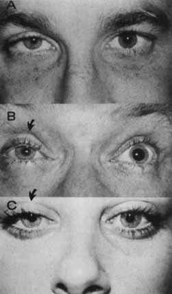 Ipsilateral Horner Syndrome Cerebrovascular Accident