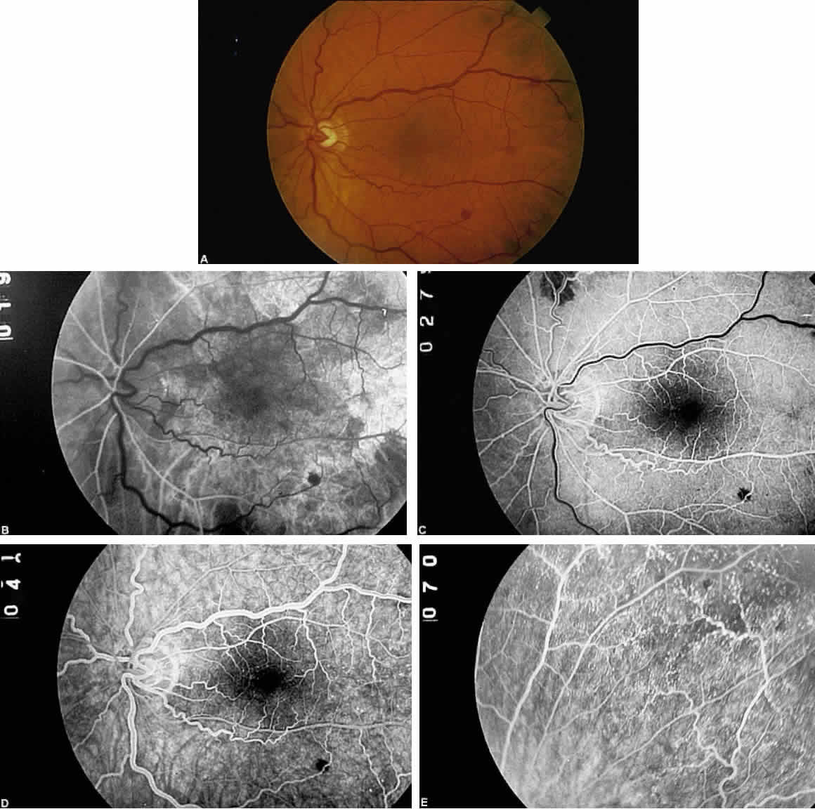 venous stasis retinopathy vs ocular ischemic syndrome)