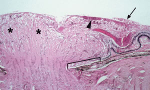 subhyaloid retinal hemorrhages