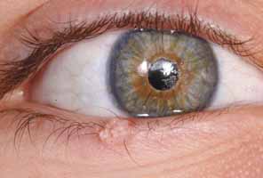 Dermatology Eyelids Doctor Answers, Q&A, Tips - RealSelf