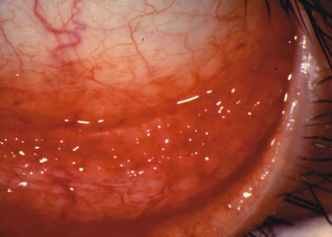 follicular conjunctivitis histology