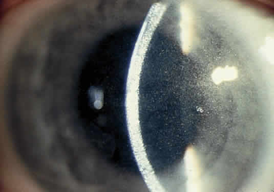 Cornea Farinata