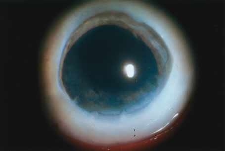What is corneal edema?