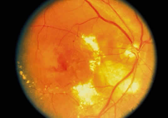 ocular tuberculosis