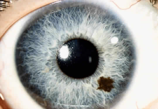 iris melanocytoma