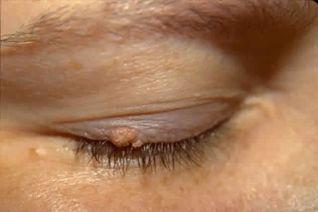 papilloma on eyelid