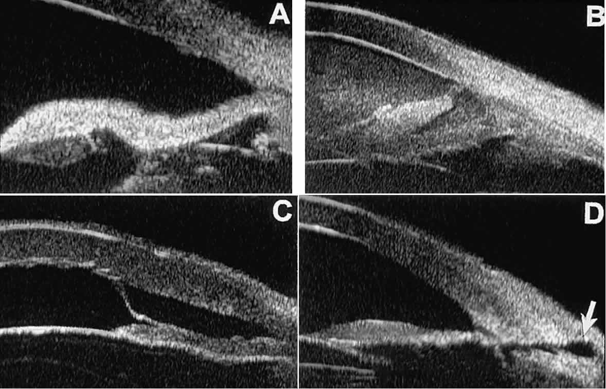 Hyphema Of Iris