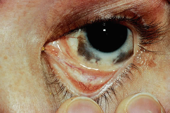 White Patch On Sclera