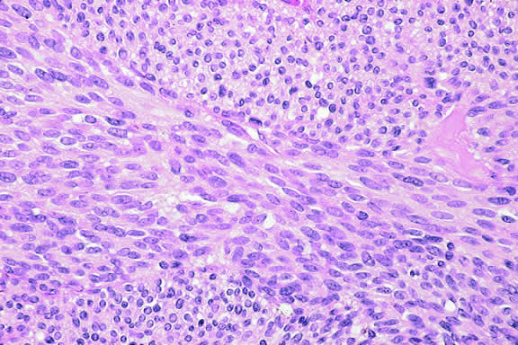 spindle cell melanoma