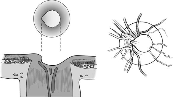 Topographic sketch. Coronal view of bilateral DRT (orange). Patient